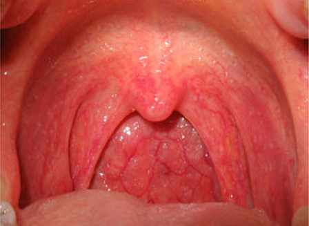 Five items to cure sore throat when a doctor is not readily available