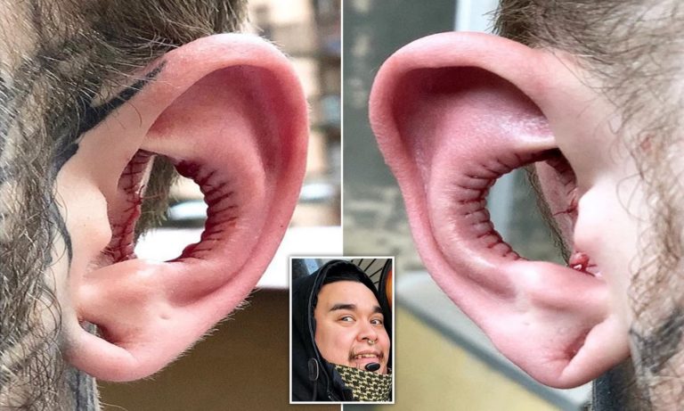 Conch Removal: Here is all you need to know including pictures
