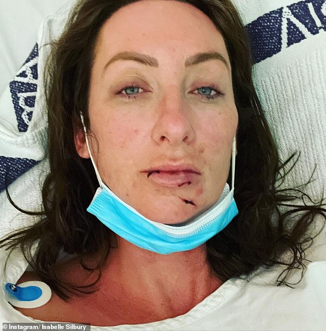 Gogglebox star Isabelle Silbery reveals she has broken her JAW in horrific accident 1